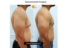 Gynecomastia Before and After: What Results Really Look Like